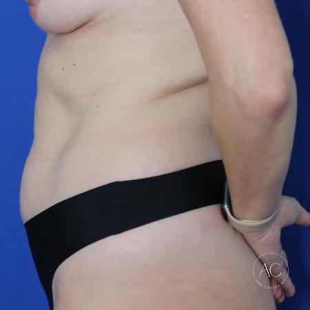Before image 3 Case #122721 - Circumferential Trunk Liposuction Abdominoplasty
