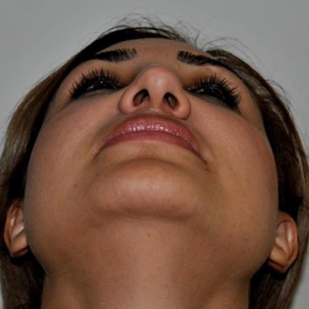 Before image 6 Case #122601 - Aging Rhinoplasty