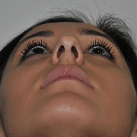 Before image 6 Case #122611 - Aesthetic Reduction Rhinoseptoplasty