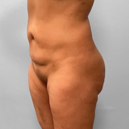 After image 2 Case #123191 - Liposuction