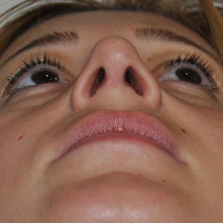 After image 6 Case #122796 - Aesthetic Reduction Conventional Rhinoseptoplasty