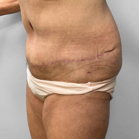 After image 2 Case #123256 - Tummy Tuck