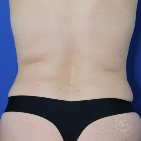 Before image 5 Case #122721 - Circumferential Trunk Liposuction Abdominoplasty