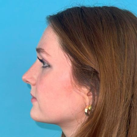 Before image 3 Case #123106 - My cute little NATURAL nose...