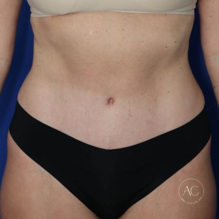 After image 1 Case #122721 - Circumferential Trunk Liposuction Abdominoplasty