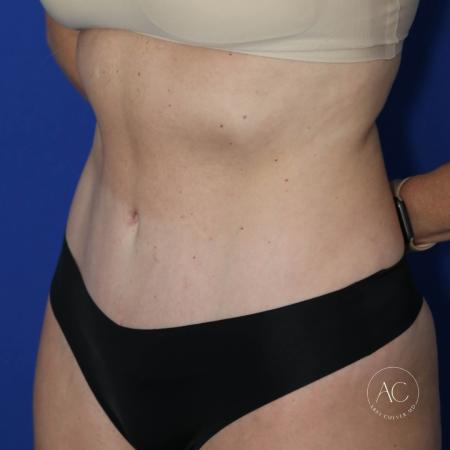 After image 2 Case #122721 - Circumferential Trunk Liposuction Abdominoplasty