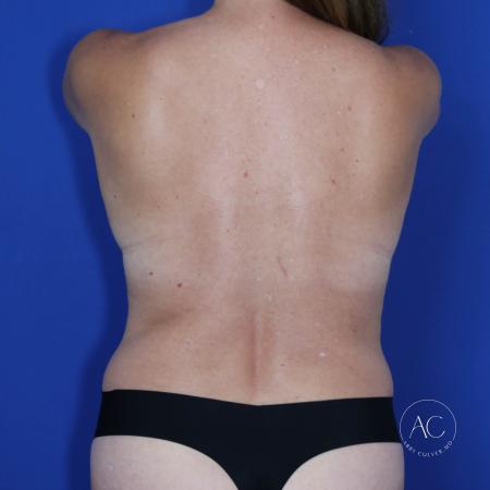 Before image 5 Case #123036 - Breast augmentation - lift and lipoabdominoplasty