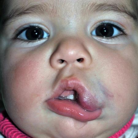 Before image 1 Case #122871 - Congenital Vascular Malformation
