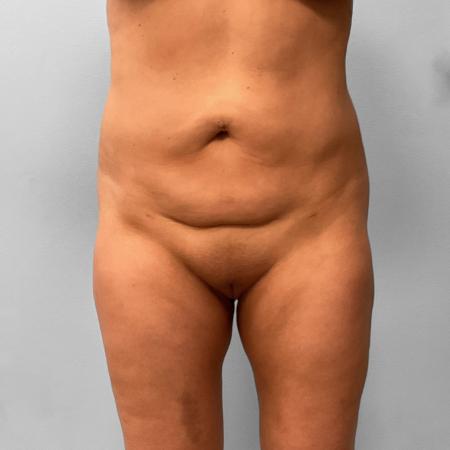 After image 1 Case #123191 - Liposuction