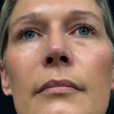 After image 4 Case #122781 - rhinoplasty case