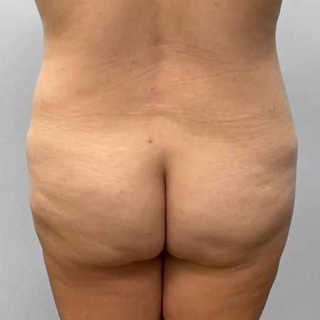 Before image 4 Case #123236 - Tummy Tuck