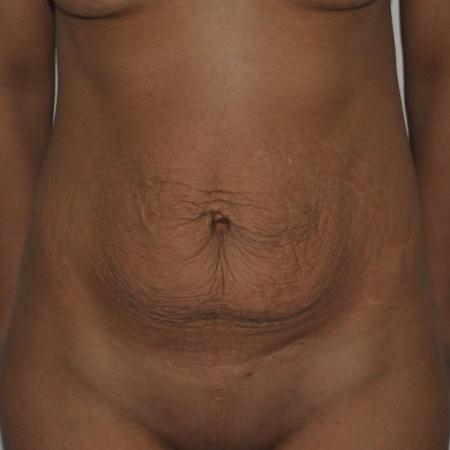 Before image 1 Case #122716 - Abdominoplasty