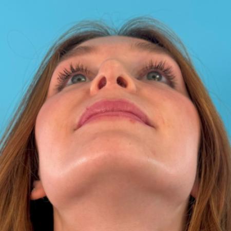 After image 6 Case #123106 - My cute little NATURAL nose...