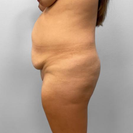 Before image 3 Case #123236 - Tummy Tuck