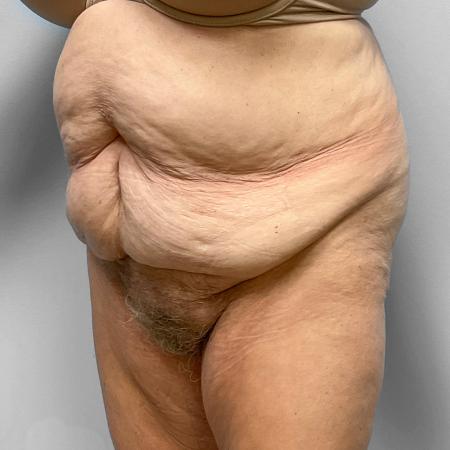 Before image 2 Case #123256 - Tummy Tuck