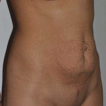 Before image 2 Case #122716 - Abdominoplasty