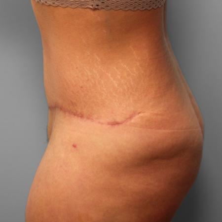 After image 3 Case #123251 - Tummy Tuck