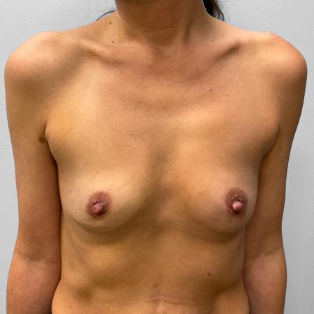 Before image 1 Case #123241 - Breast Augmentation