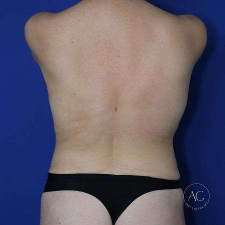After image 5 Case #123166 - Breast lift with circumferential trunk liposuction