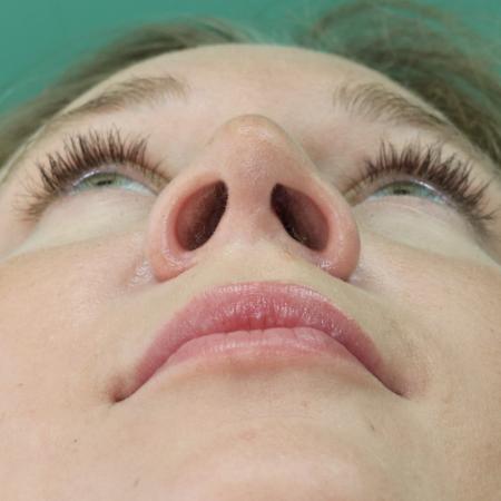 After image 6 Case #122876 - Nasal Deviation Syndrome. Rhinogenic Headache 