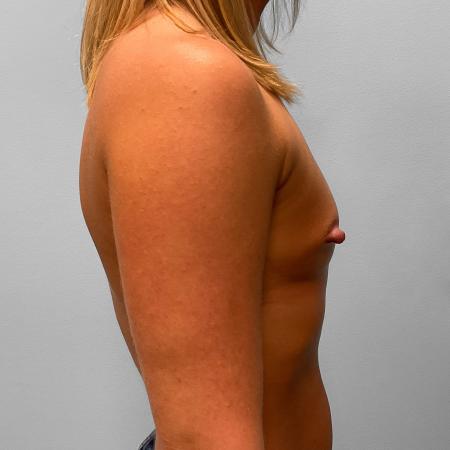 Before image 3 Case #123201 - Breast Augmentation