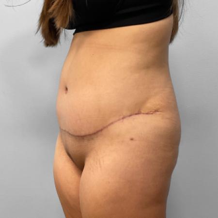 After image 2 Case #123236 - Tummy Tuck
