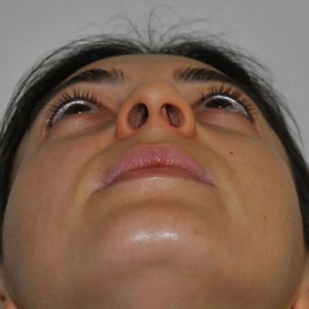 Before image 6 Case #122636 - Aestetic Reduction Rhinoseptoplasty