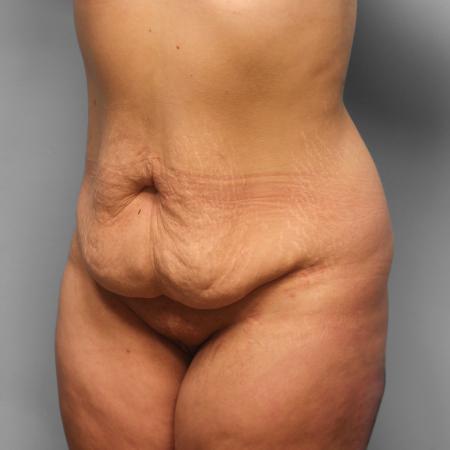 Before image 2 Case #123251 - Tummy Tuck