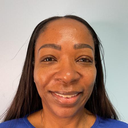 After image 1 Case #123271 - 47 year-old female with dermal fillers