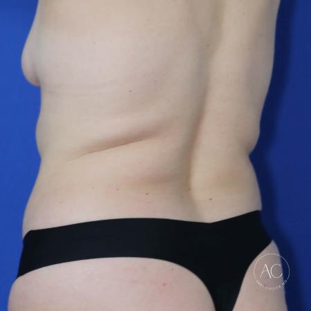 Before image 4 Case #122721 - Circumferential Trunk Liposuction Abdominoplasty