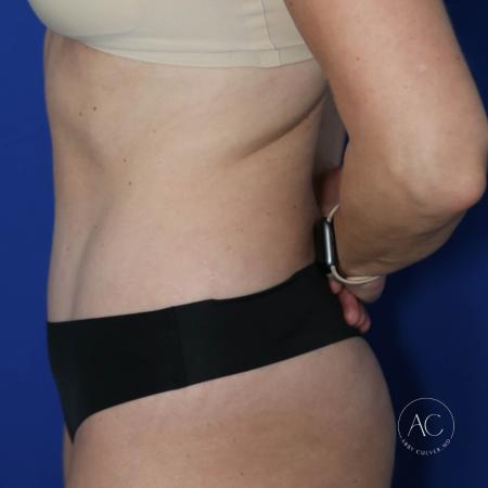 After image 3 Case #122721 - Circumferential Trunk Liposuction Abdominoplasty