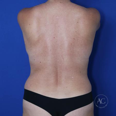 After image 5 Case #123036 - Breast augmentation - lift and lipoabdominoplasty