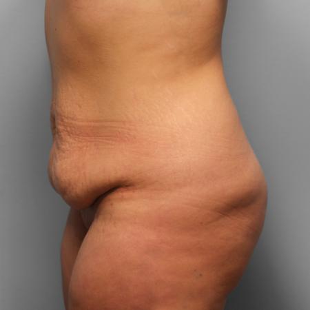 Before image 3 Case #123251 - Tummy Tuck
