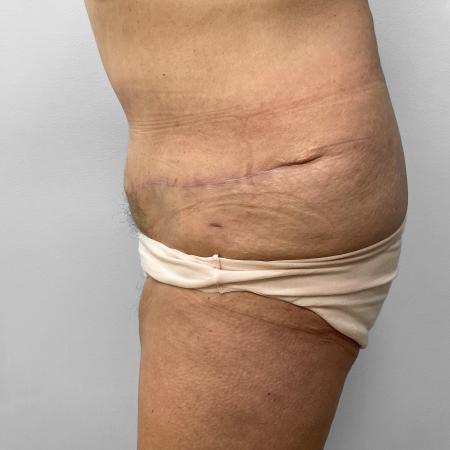 After image 3 Case #123256 - Tummy Tuck