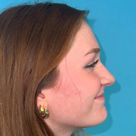 Before image 5 Case #123106 - My cute little NATURAL nose...