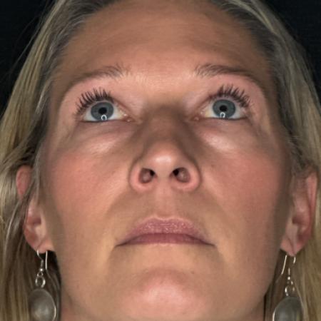 Before image 4 Case #122781 - rhinoplasty case