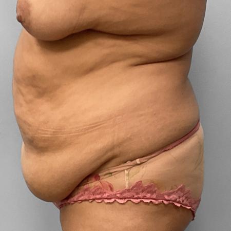 Before image 3 Case #123196 - Tummy Tuck
