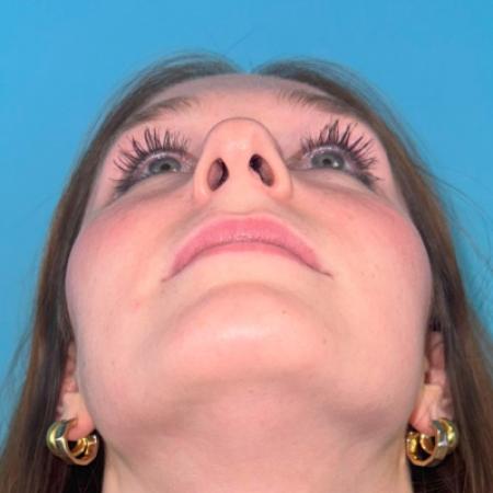 Before image 6 Case #123106 - My cute little NATURAL nose...