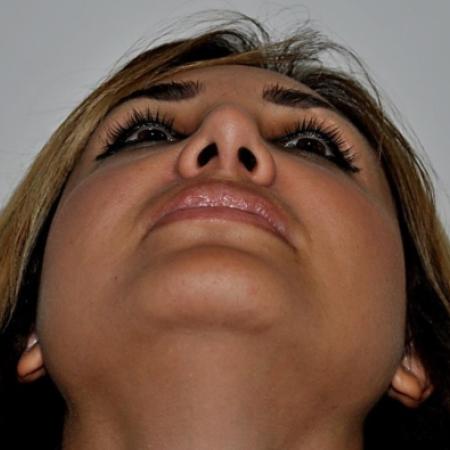 After image 6 Case #122601 - Aging Rhinoplasty