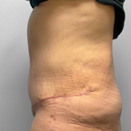 After image 3 Case #123231 - Tummy Tuck