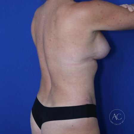 After image 4 Case #123036 - Breast augmentation - lift and lipoabdominoplasty