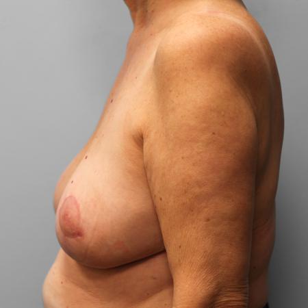 After image 3 Case #123206 - Breast Reduction