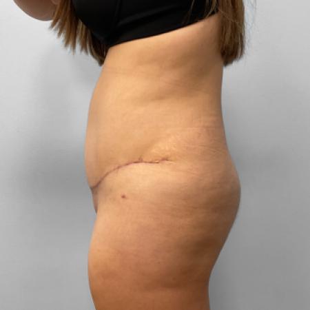 After image 3 Case #123236 - Tummy Tuck