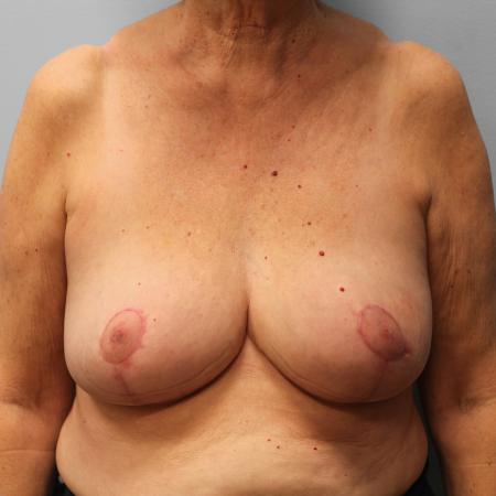 After image 1 Case #123206 - Breast Reduction