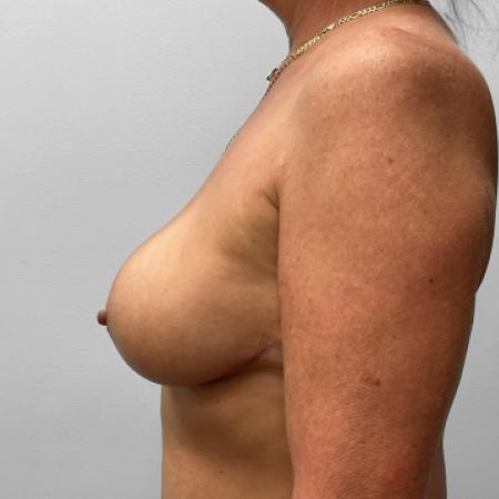 After image 3 Case #123181 - Breast Lift and Implant Removal