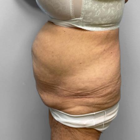 Before image 3 Case #123186 - Tummy Tuck