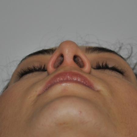 After image 6 Case #122741 - Primary Rhinoseptoplasty, Turbinate Lateralization
