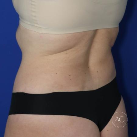 After image 4 Case #122721 - Circumferential Trunk Liposuction Abdominoplasty