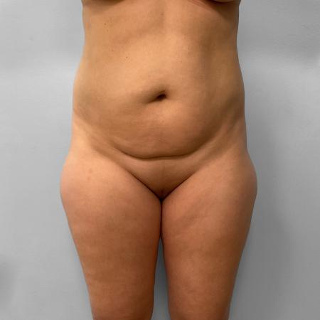 Before image 1 Case #123191 - Liposuction