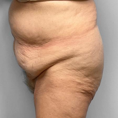 Before image 3 Case #123256 - Tummy Tuck
